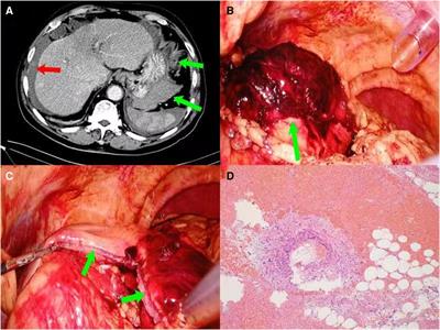 Case report: Laparoscopic treatment of gastro-omental hemangioma with hemorrhage: two cases reports and review of literature